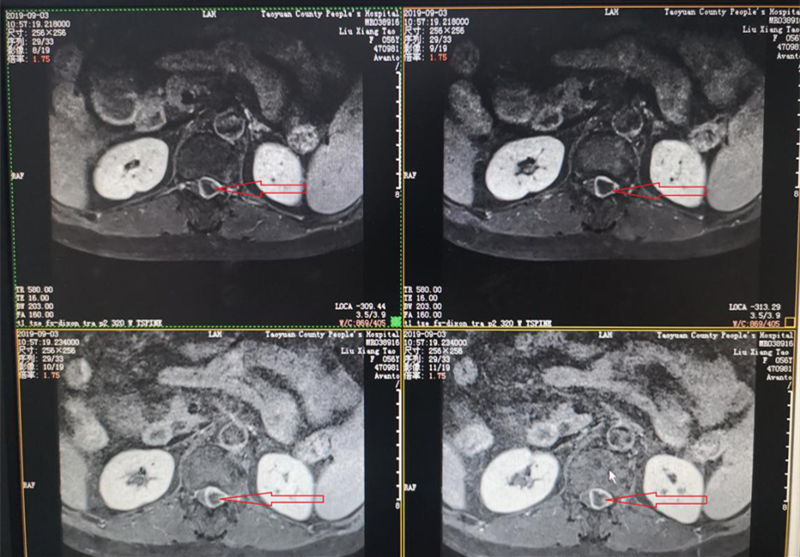 001-術(shù)前MRI,箭頭所指即椎管內(nèi)腫瘤.png